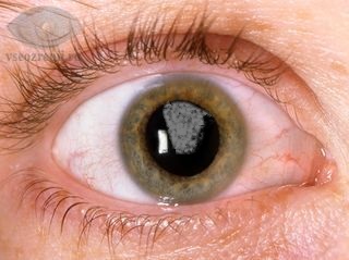 Тренировка. Любое заболевание - определенные условия. - Cataract.jpg